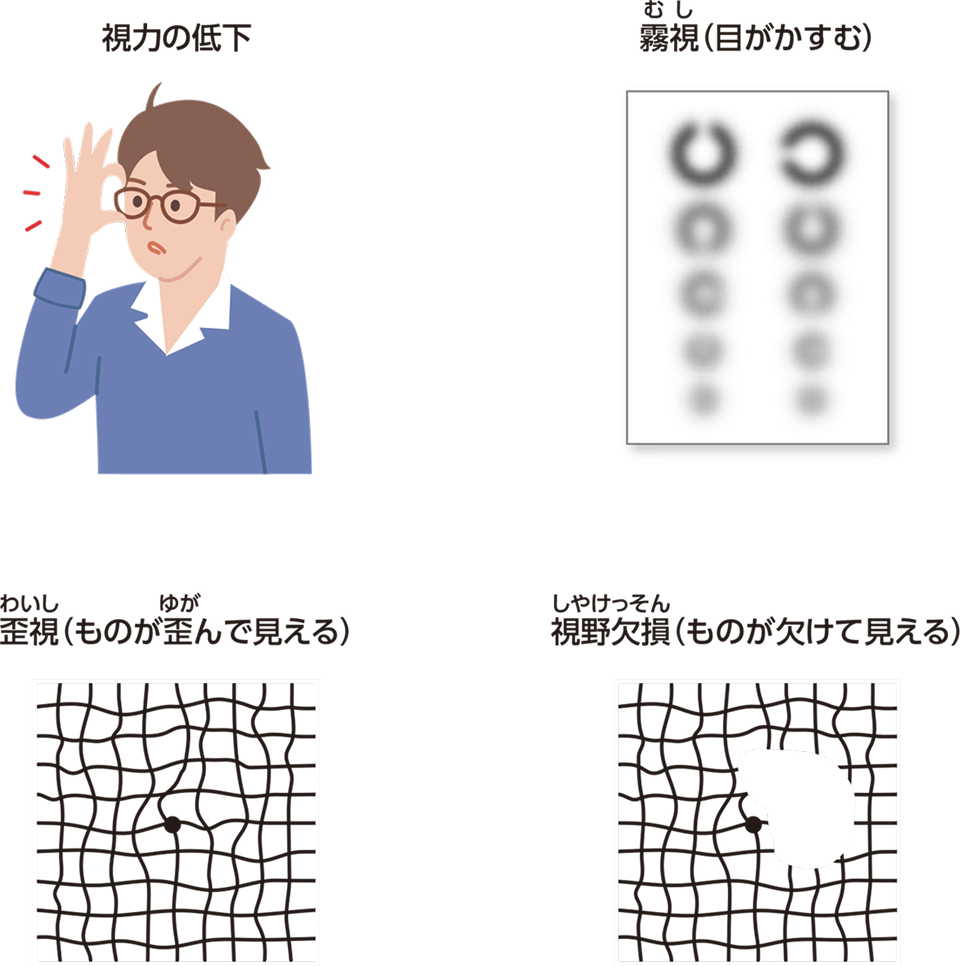 症状である視力の低下、霧視（目がかすむ）、歪視（ものが歪んで見える）、視野欠損（ものが欠けて見える）を示すイラスト