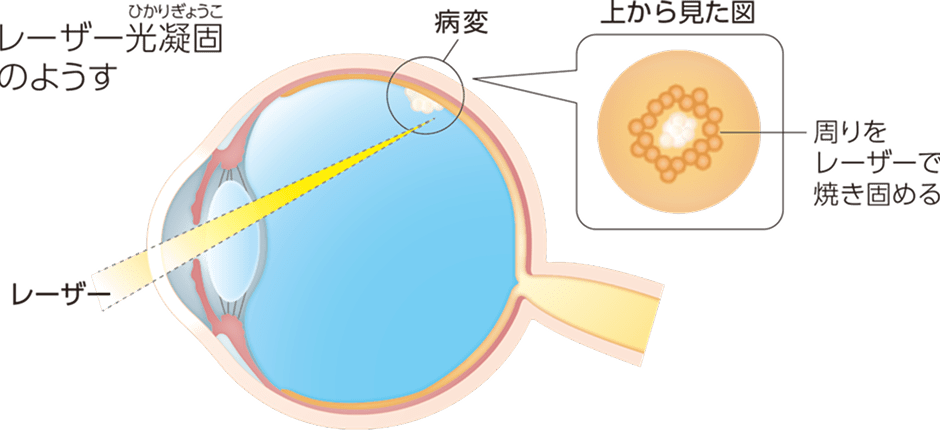 レーザー光凝固のイラスト