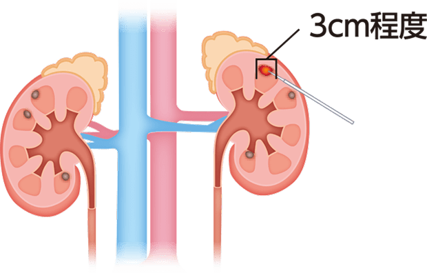 腫瘍が3cm程度を示すイラスト