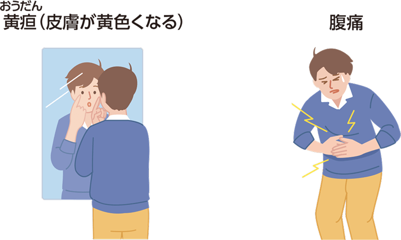 症状である黄疸（皮膚が黄色くなる）、腹痛を示すイラスト